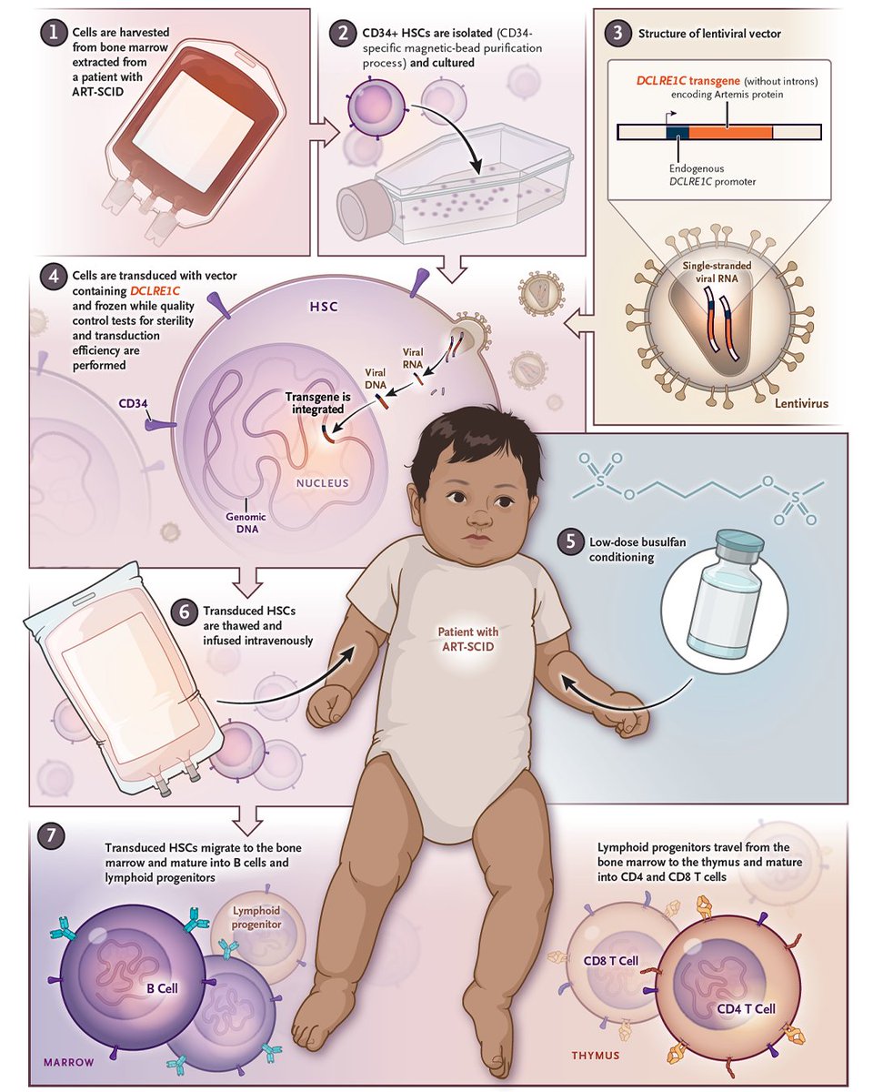 This editorial discusses the science behind a study involving 10 patients with ART-SCID, in which low-dose busulfan conditioning combined with a tweak to a gene-therapy vector resulted in favorable outcomes. nej.md/3Yzc3Hf