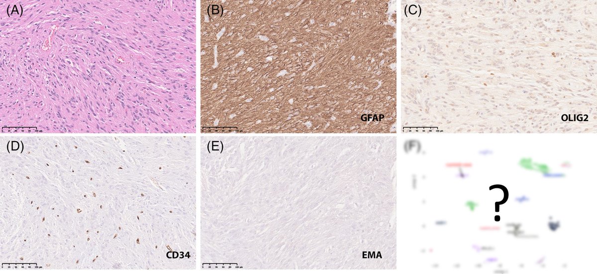 UNDER YOUR MICROSCOPE: A 64-year-old woman with frontal lobe lesion and drug-resistant epilepsy
@jinxueting @NCIKenAldape <a href="/NIHBrainTumor/">NIHBrainTumor</a> @NCIResearchCtr #neuropath
Whole slide image: isn-slidearchive.org/?col=ISN&fol=A… 

What's your diagnosis? Find out here: onlinelibrary.wiley.com/doi/10.1111/bp…