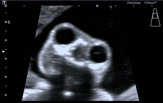 Pregnant woman came for a routine obstetric ultrasound to investigate a possible malformation in the central nervous system of the fetus.

21 weeks 2 days

Diagnosis?