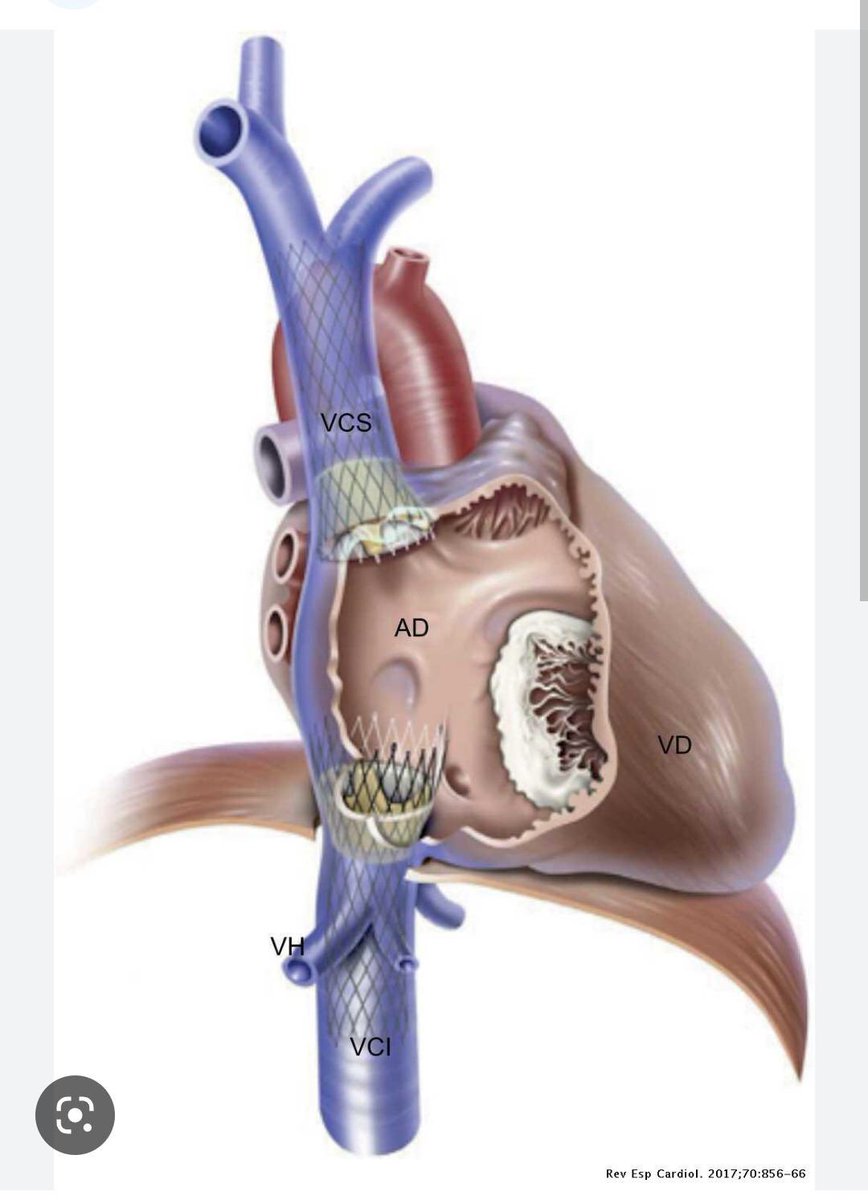 Excelentes casos de insuficiencia tricúspide tratados con el sistema #Tricvalve en <a href="/Hospital_LaLuz/">Hospital La Luz</a> Quironsalud.
Enhorabuena al equipo de la Unidad de Hemodinámica y Cardioogía Intervnecionista, Dr <a href="/JorgPalazuelos/">Jorge Palazuelos</a> al Dr <a href="/jmmoreiras/">Javi Moreiras</a>,<a href="/danielegemma1/">Daniele Gemma </a>, Ana Casado. <a href="/UICARdiologia/">Unidad Integral de Cardiología - UICAR</a>