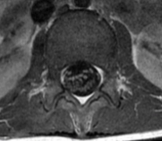 Daniel Gewolb, MD (@daniel_gewolb) on Twitter photo Child presents with weakness. MR shows enhancement of the pial surface of the conus and ventral cauda equina nerve roots.
#radtwitter #MedTwitter #radres #futureradres #Pediatrics #Neurology <a href="/TheASNR/">The American Society of Neuroradiology</a> <a href="/The_ASPNR/">American Society of Pediatric Neuroradiology</a> <a href="/AlbanyMedRadRes/">Albany Med Radiology Residency</a> Child presents with weakness. MR shows enhancement of the pial surface of the conus and ventral cauda equina nerve roots.
#radtwitter #MedTwitter #radres #futureradres #Pediatrics #Neurology <a href="/TheASNR/">The American Society of Neuroradiology</a> <a href="/The_ASPNR/">American Society of Pediatric Neuroradiology</a> <a href="/AlbanyMedRadRes/">Albany Med Radiology Residency</a>