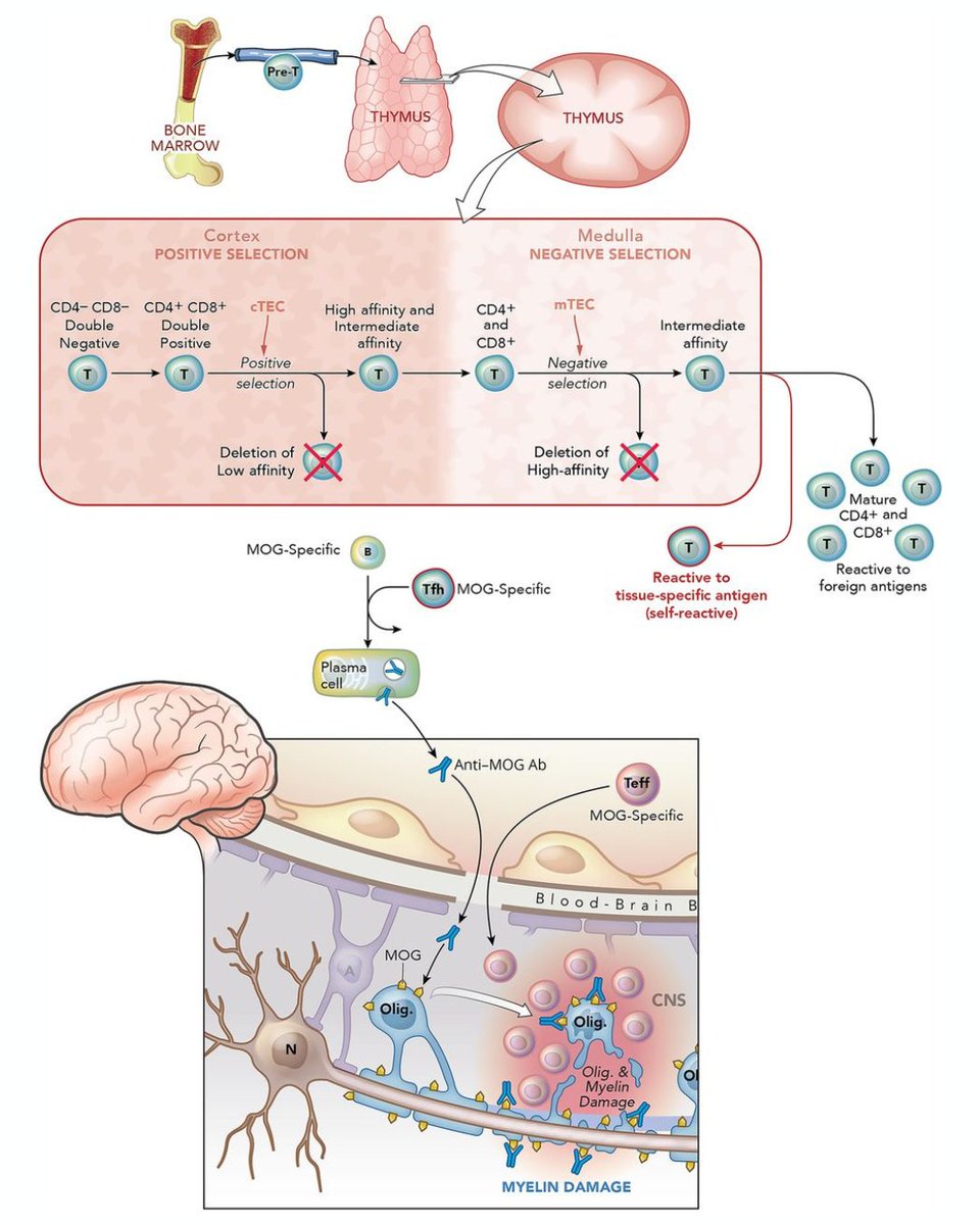 Neurology Journal on Twitter "MOG AntibodyAssociated Disease and