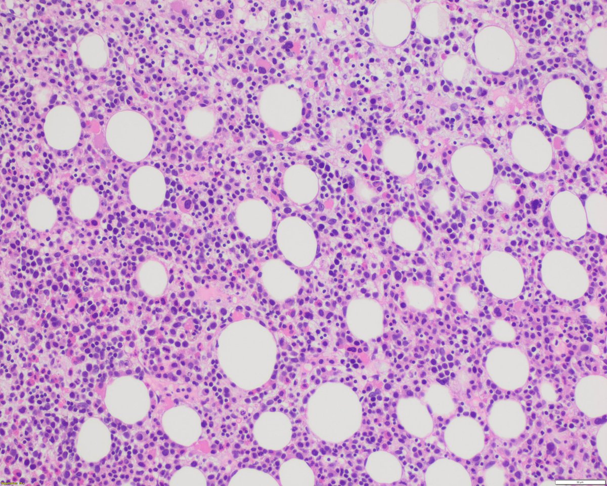 sanamloghavi's tweet image. I  love cases that make me think.. Never a dull day at #hemepathMDA
Tune in: a #hemepath #MDSSM case for your learning pleasure.. Enjoy!
This is the bone marrow of an elderly woman (&amp;gt;65 yr) with marked pancytopenia and progressive transfusion dependency. 🧵 1/