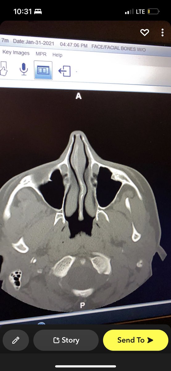 me: “idk why my head always hurts”
also me: