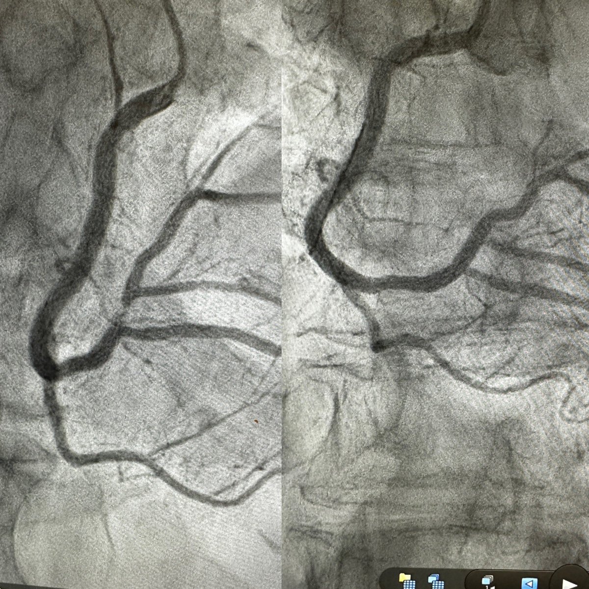 Ali Ebrahimi (@docebrohimi) on Twitter photo The IVUS guided stent may have taken 5 minutes but equally as impactful was the 45 minutes spent with my attending <a href="/MustafaAhmedMD/">Mustafa Ahmed</a> , the patient and family about GDMT and smoking cessation. FinishTheJob. #FTJ <a href="/PhillipASmithMD/">Phillip Smith</a> <a href="/BaranAksutMD/">Baran Aksut</a> The IVUS guided stent may have taken 5 minutes but equally as impactful was the 45 minutes spent with my attending <a href="/MustafaAhmedMD/">Mustafa Ahmed</a> , the patient and family about GDMT and smoking cessation. FinishTheJob. #FTJ <a href="/PhillipASmithMD/">Phillip Smith</a> <a href="/BaranAksutMD/">Baran Aksut</a>