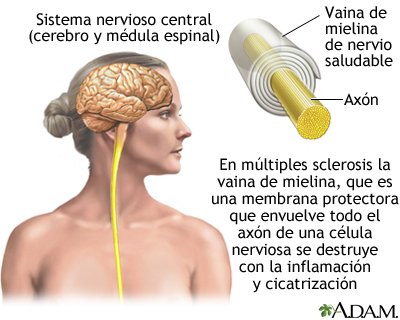 irlandamaya's tweet photo. Sabían q pacientes con esclerósis múltiple de hospital Adolfo López Mateos @ISSSTE_mx no están recibiendo sus medicamentos desde hace 1mes?(Natalizumab)porq sus Oficinas Centrales,área PEMDI,no libera folios!Mientras,salud de pacientes se deteriora!Burocratismo también mata!. https://t.co/bO6dOfOgeE