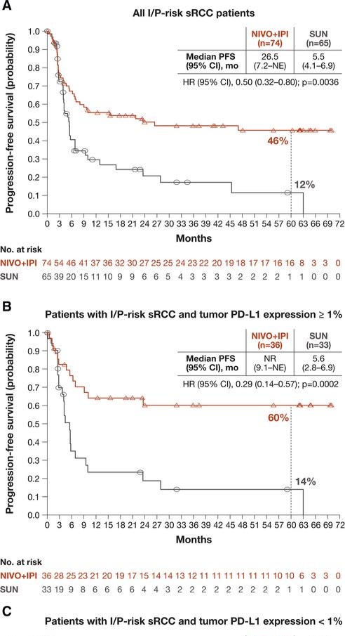 drenriquegrande's tweet photo. ⚡️ Long-term outcomes with nivolumab plus ipilimumab versus sunitinib in first-line treatment of patients with advanced sarcomatoid renal cell carcinoma 

@brian_rini @DrChoueiri @montypal @jitcancer #kidneycancer

https://t.co/G8gpuf9peN https://t.co/AIFgGhUgyJ