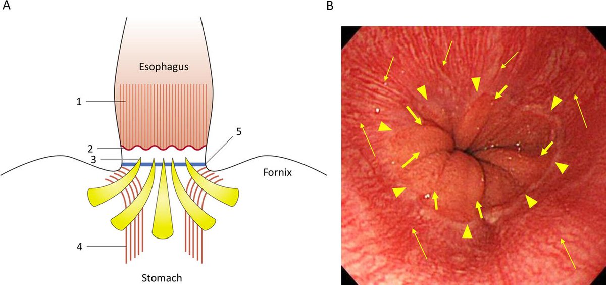 Gut_BMJ's tweet photo. Included (in no particular order) as a #GUTTopPaper chosen by @emadelomar is
"Kyoto international consensus report on anatomy, pathophysiology and clinical significance of the gastro-oesophageal junction" via
https://t.co/yTOQhyyecm
#GOJ #GastricCancer https://t.co/cOiaBJEBtX