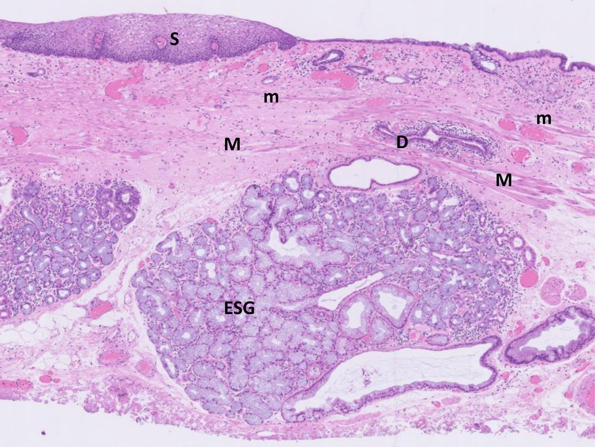 Gut_BMJ's tweet photo. Included (in no particular order) as a #GUTTopPaper chosen by @emadelomar is
"Kyoto international consensus report on anatomy, pathophysiology and clinical significance of the gastro-oesophageal junction" via
https://t.co/yTOQhyyecm
#GOJ #GastricCancer https://t.co/cOiaBJEBtX