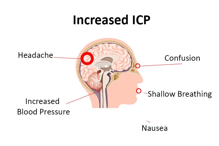 sthanu-on-twitter-q-for-elevated-intracranial-pressure-icp-few