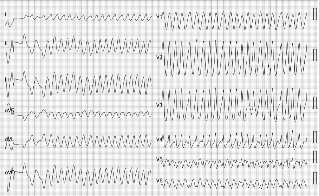 cardioparis's tweet photo. A 37 y-o male patient without cardiac history with syncope during the world-cup final. What do you think ?
#Cardiotwitter #CardioEd #EPeeps #ecg. Thanks to @PMcardioBot for digitalization https://t.co/Ffn5oFQFOb