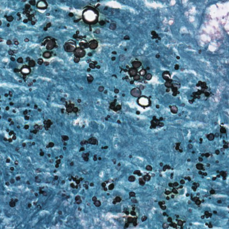 olkazuraw's tweet photo. In search of a green Grocott-stained slide to tap into the Christmas mood, found this whole slide image.
The black staining structures are Paracoccidioides yeasts. 
#pathpresenter #specialstains #histopathology #paracoccidioidomycosis #pathart https://t.co/LhVS9rpKjv