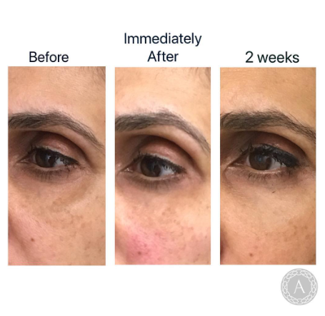 AestheticsAvika's tweet photo. Under #eye hollowing and tear trough treatment with 1ml #Juvederm #Volbella. Satisfactory results, no downtime, lasting results.
Worried about #tiredeyes?
Get in touch, we may be able to help!
#antiaging #fillers #allergan #vycross #youngerskin #london #love #beauty https://t.co/3jdH4RqQOs