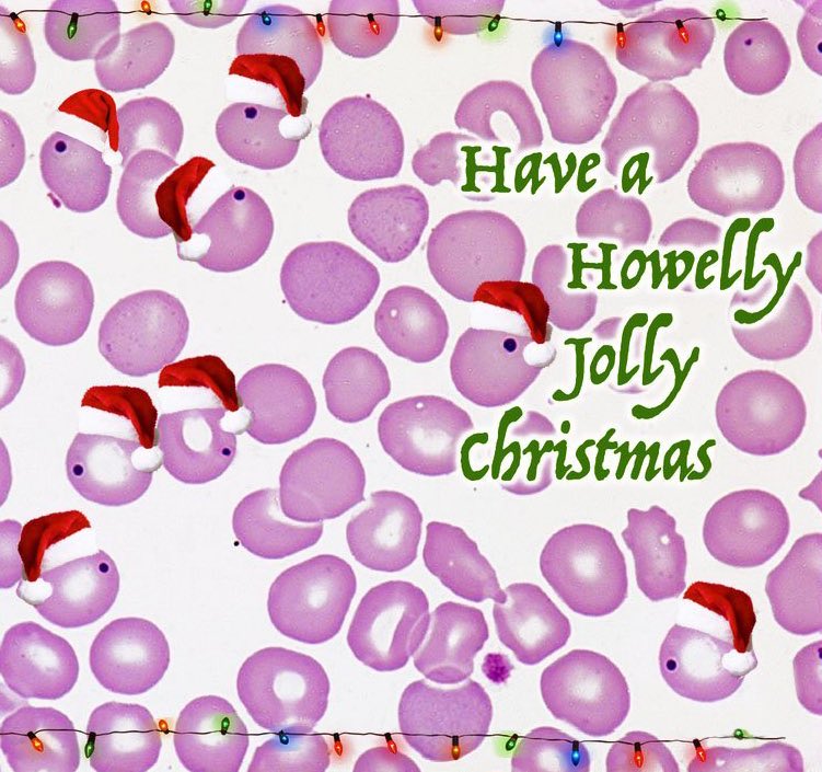 IHeartHisto's tweet photo. 🎅Have a Howelly-Jolly Christmas🎄

A festive finding in the blood of an asplenic patient 💉 

A Howell–Jolly body is a cytopath finding where remnants of DNA are present in circulating erythrocytes. Normally these cells are removed by the spleen!

#histology #anatomy #pathology https://t.co/w5b4fa7mfC