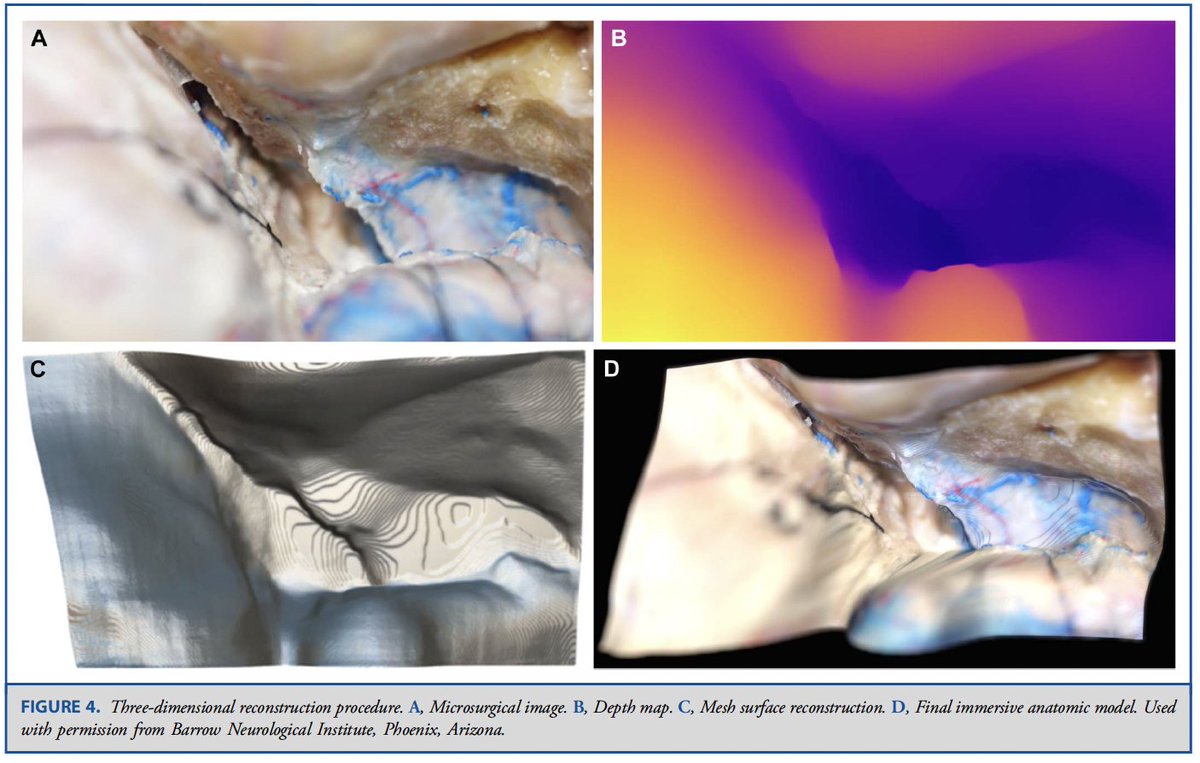 giancarlomignu1's tweet photo. Proud of our #publication in Operative Neurosurgery @CNS_Update on our #3D #machinelearning technology where 2D dissection photos are converted to 3D models for #neurosurgery #education. Technology created and validated by our team! Link:

https://t.co/RlMpQhvudj

@BarrowNeuro https://t.co/NP3nbpRukg