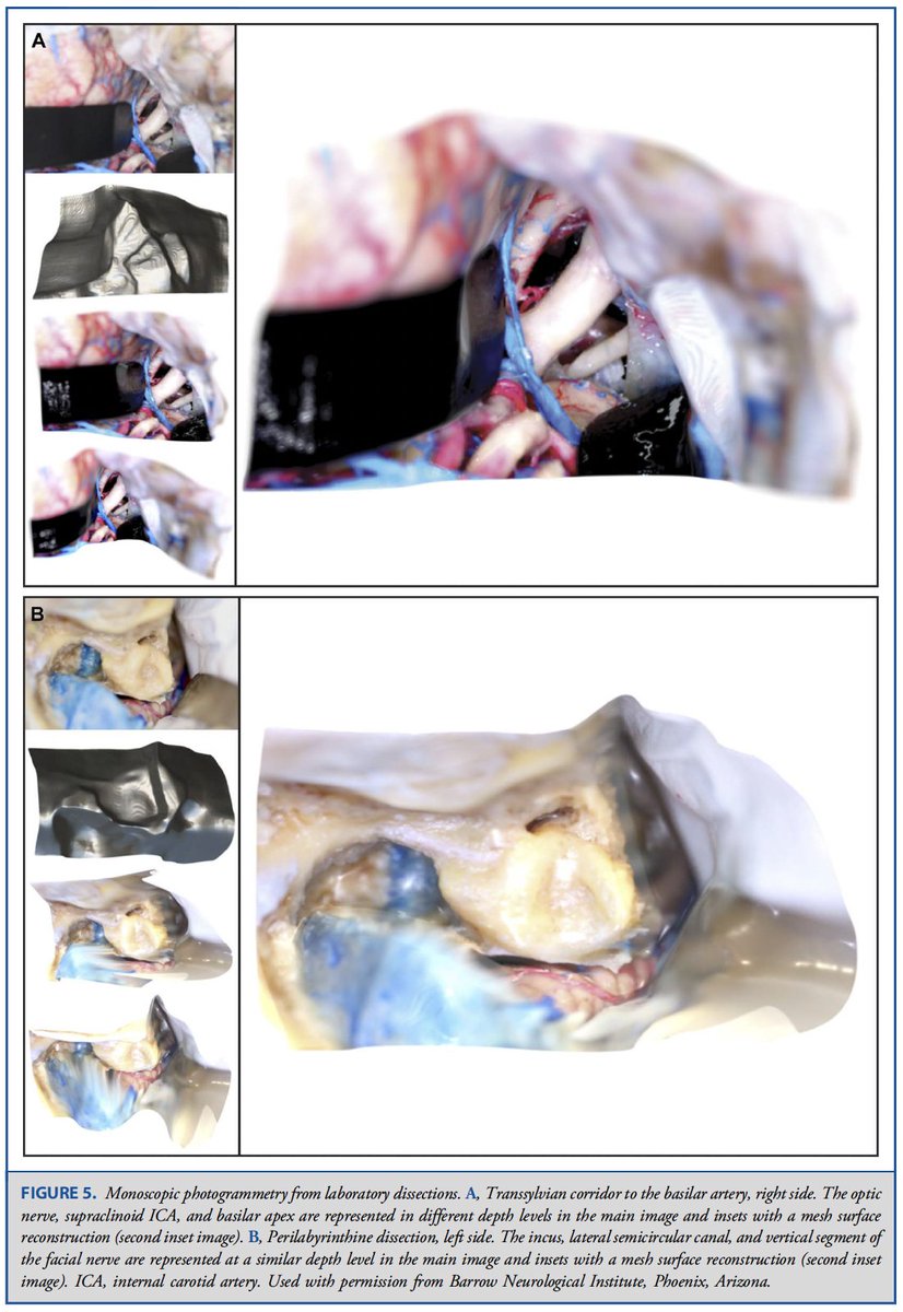 giancarlomignu1's tweet photo. Proud of our #publication in Operative Neurosurgery @CNS_Update on our #3D #machinelearning technology where 2D dissection photos are converted to 3D models for #neurosurgery #education. Technology created and validated by our team! Link:

https://t.co/RlMpQhvudj

@BarrowNeuro https://t.co/NP3nbpRukg