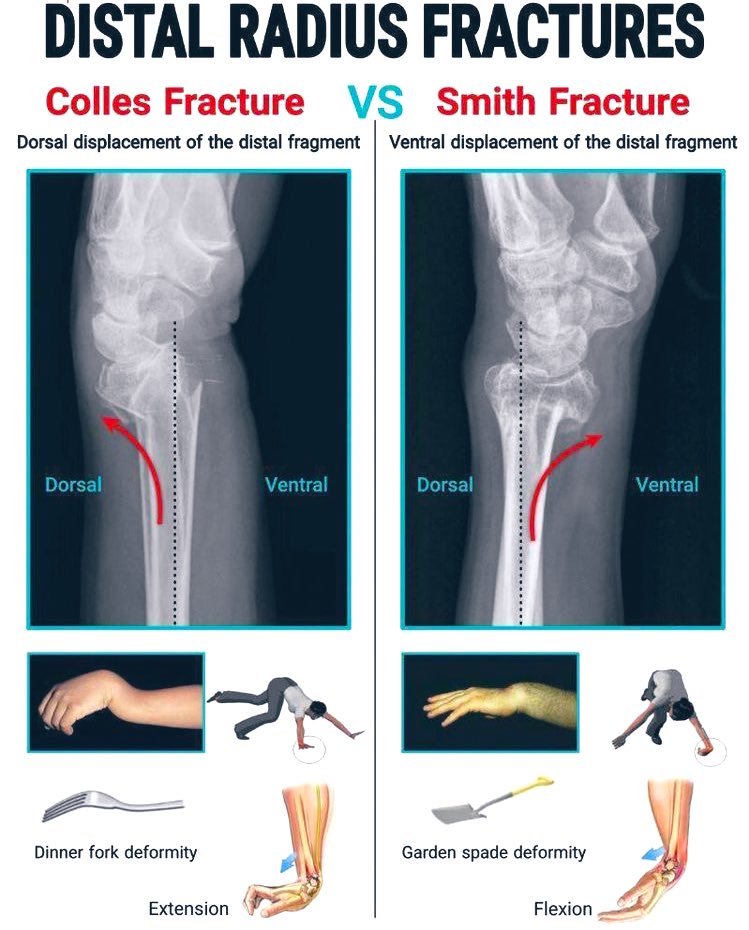 Iaa_Hk's tweet photo. Distal Radius Fractures #MedTwitter #orthotwitter #fractures #trauma #orthopaedics https://t.co/tdoaPrIQGu