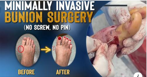 Rasel01611's tweet photo. Minimally Invasive Bunionectomy System Surgical Technique (NO Screw, NO Pin) | Reverse-Austin
Video Link:https://t.co/6Yhml3cOzL
#physician
#bunion_foot_surgery
#foot_and_ankle
#surgery
#Healthcare
#bunion_foot_surgery
#surgery_videos https://t.co/K3GpU5styV