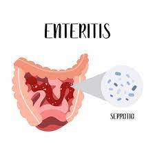 _Woman_health's tweet image. #Enteritis - Treatments In Traditional Chinese medicine perspective kylejnorton.blogspot.com/2013/12/enteri…