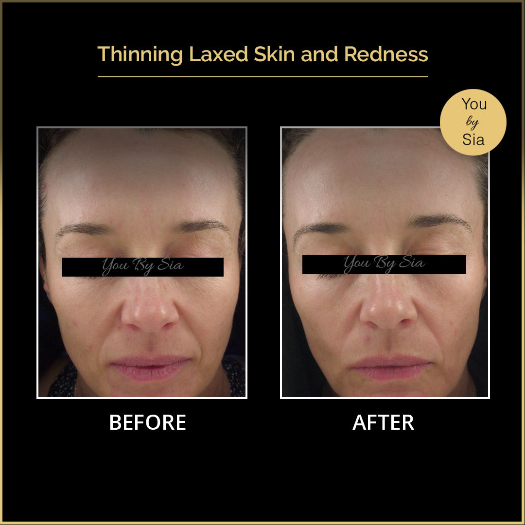 YouBySia's tweet image. 3 treatments done in 1 month, client used clenz, release and other clinicals product, they achieved firmer, plump and smoother skin only in 12 weeks!

Call us at (02)83237510 to book your appointment or visit us at youbysia.com.au to know more!

#thermique #clenz #release