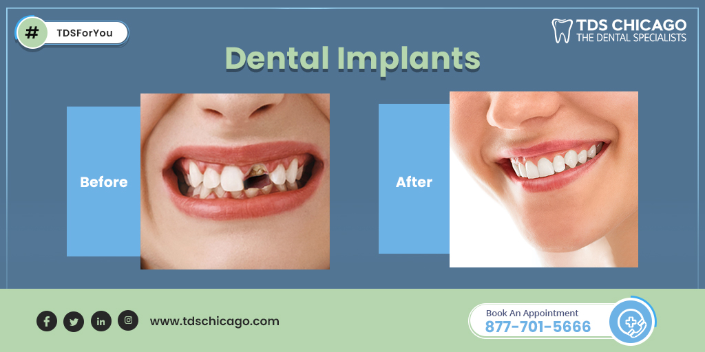 tds_chicago's tweet photo. Give yourself a beautiful smile with EON Clinics dental implants!

Click https://t.co/LlDz64RWby or call +877-701-5666 to know more.

#DentalImplants #TDSForYou #Chicago #DentalClinic https://t.co/PLbI3CvzLJ