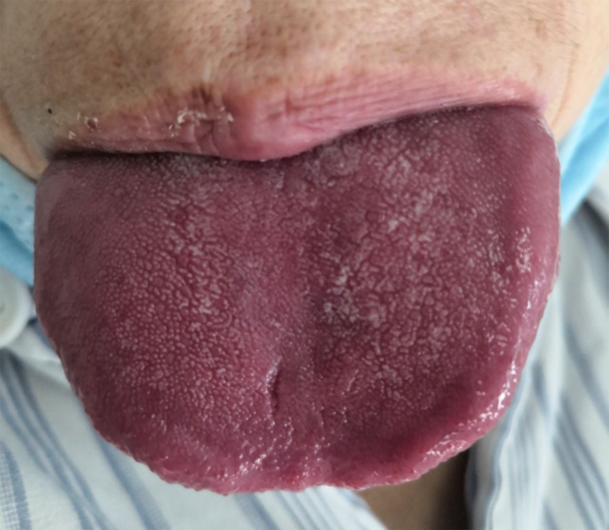 FrontGastro_BMJ's tweet photo. Interesting case online now via the @FrontGastro_BMJ website:
"Unusual case of abdominal tenderness" via
https://t.co/XMtUuMDUYU
#Macroglossia #FGImage @RMBeattie50 https://t.co/DDX28ivSba