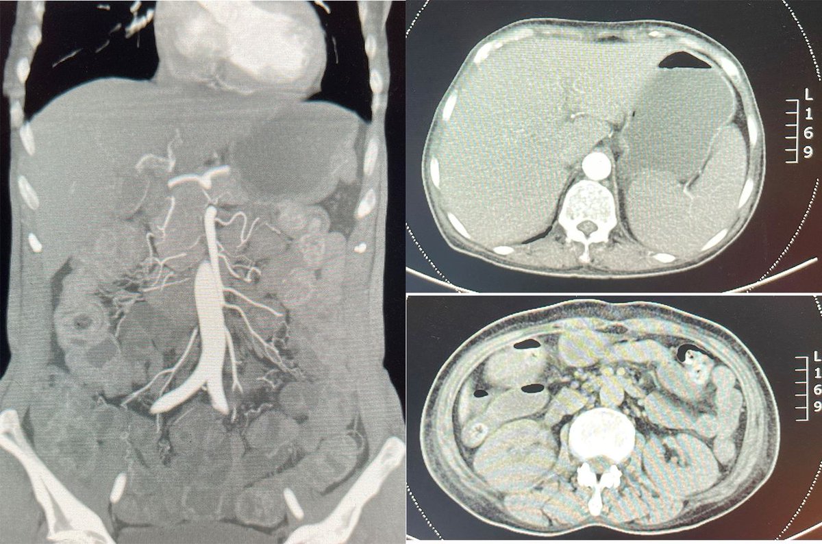 FrontGastro_BMJ's tweet photo. Interesting case online now via the @FrontGastro_BMJ website:
"Unusual case of abdominal tenderness" via
https://t.co/XMtUuMDUYU
#Macroglossia #FGImage @RMBeattie50 https://t.co/DDX28ivSba