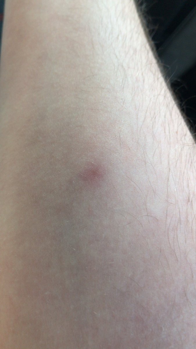 frogintraining's tweet image. anyone else got a scar from the mpox shot?