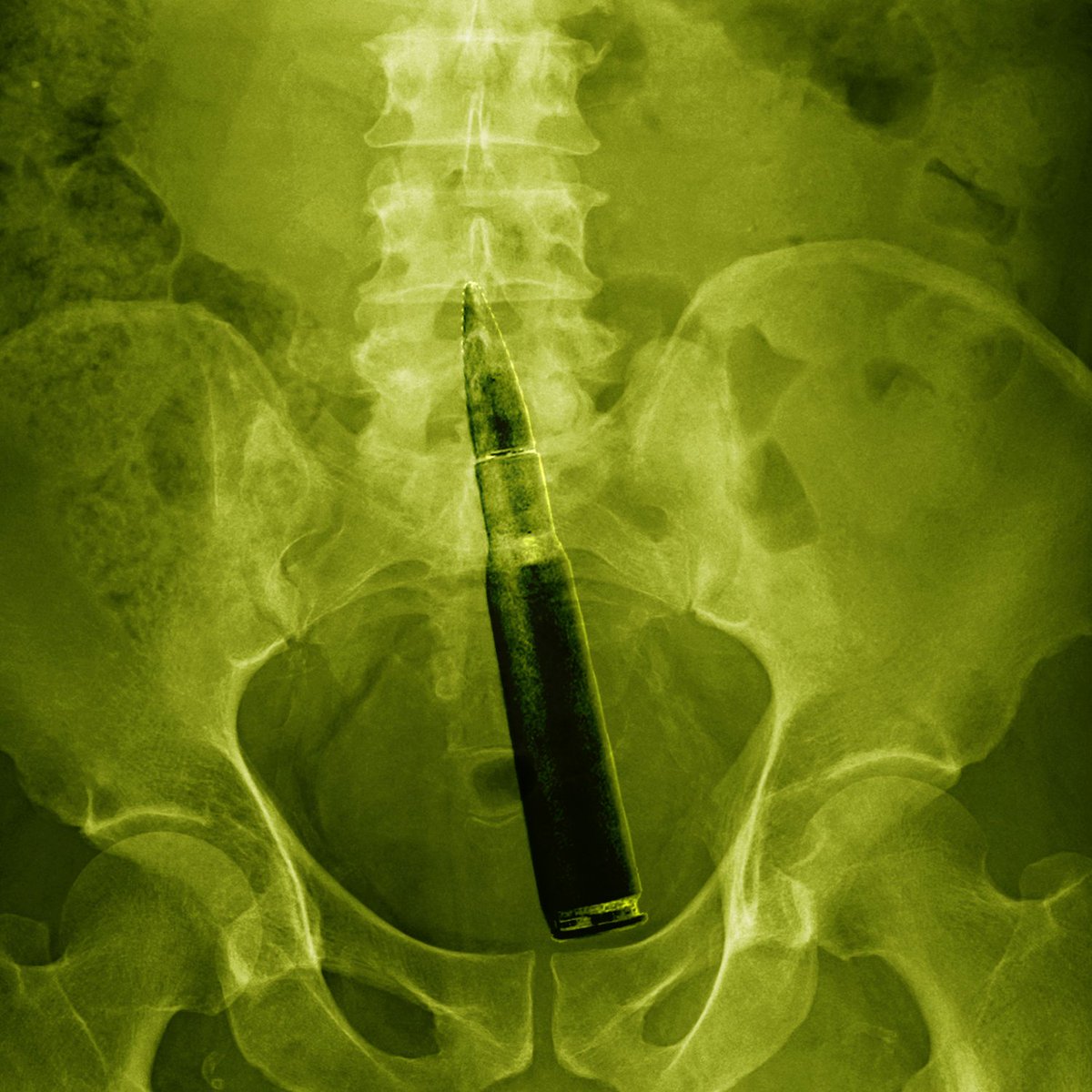 "Doctor, I have a bomb in my rectum"
Hospital evacuated. 

An 88-year-old French man arrived at a hospital with a First World War shell stuck in his anus.

#nft #NFTCollection #BOMB #BSC #BNB #NFTCommunity