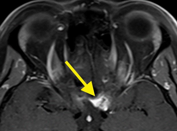 Daniel Gewolb, MD (@daniel_gewolb) on Twitter photo 45F presents with painless progressive left eye vision loss. MR shows homogenous enhancement encasing the left optic nerve with an associated lesion at the entrance of the optic canal (yellow arrow)
#radres #futureradres #NeuroRad #MedTwitter <a href="/AlbanyMedRadRes/">Albany Med Radiology Residency</a> 45F presents with painless progressive left eye vision loss. MR shows homogenous enhancement encasing the left optic nerve with an associated lesion at the entrance of the optic canal (yellow arrow)
#radres #futureradres #NeuroRad #MedTwitter <a href="/AlbanyMedRadRes/">Albany Med Radiology Residency</a>