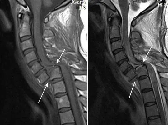 Kaçırdıklarınız: 
Spinal Kord Hasarında Steroid Tartışması Devam Ediyor Mu? - Mehmet Ali Aslaner @acilci_net için yazdı, 
Zeynep Sena KAYA seslendirdi: 
buff.ly/3D0GnSx 
#FOAMed #metilprednizolon #spinalkordbasısı #spinalkordhasarı #spinalkordyaralanması #steroid #Travma