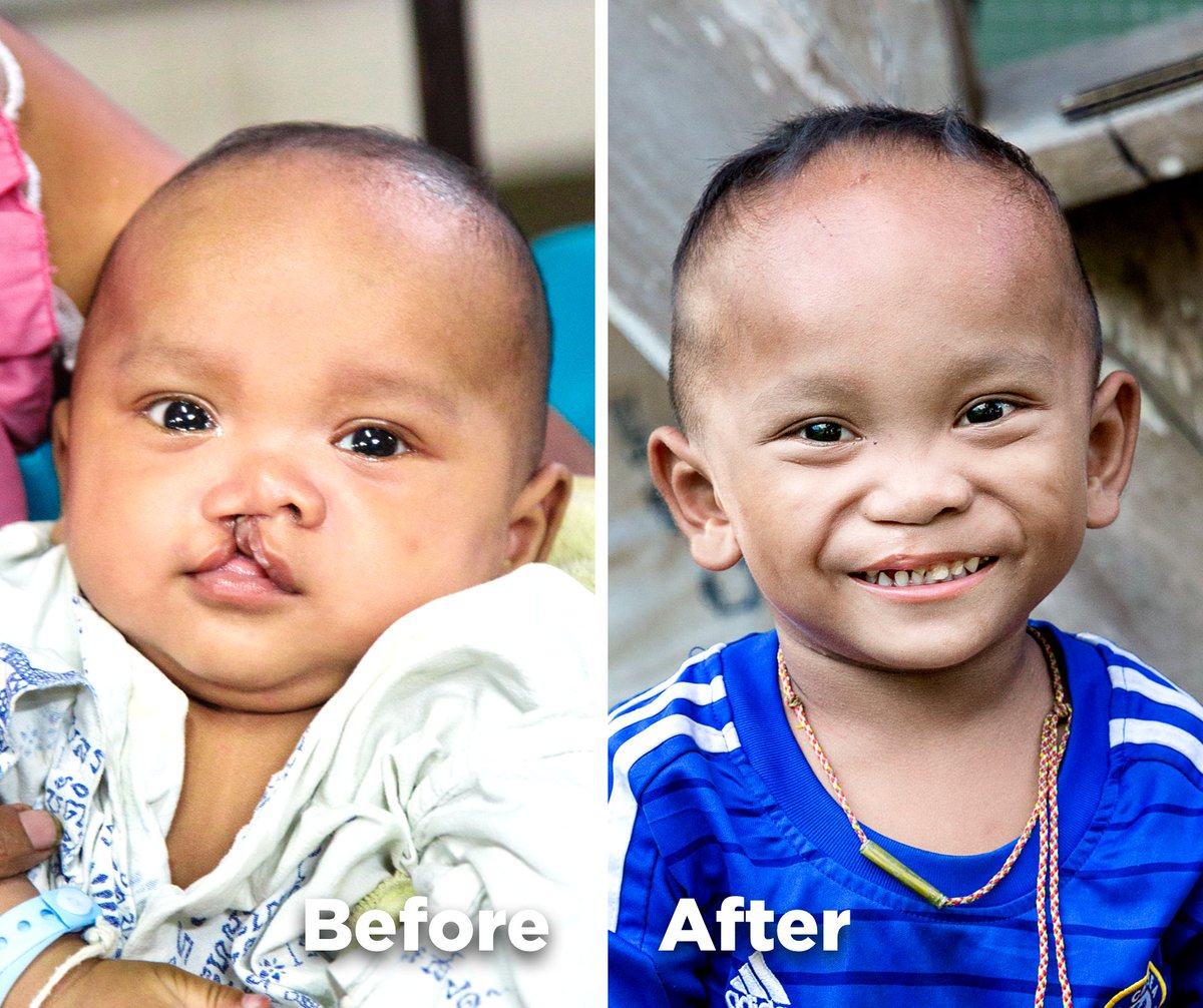 When Oat was born, his smile frightened his mom, who didn't expect to see his #cleftlip, #cleftpalate or limb difference.

After Oat’s #surgery from #OperationSmileThailand, his mom hopes he'll grow up to experience a life without bullying or teasing. #SundaySmiles
