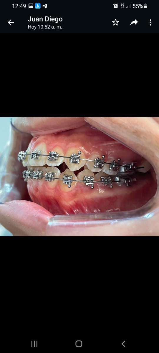 Alonso_Monty's tweet photo. @JohnnVasquezM ¡Bienvenidos a We Smile! ¡Somos un consultorio dental moderno y amigable! Ofrecemos servicios de limpieza dental, blanqueamiento y tratamientos de ortodoncia de alta calidad. ¡Ven a visitarnos y sonría con confianza!citas al 975771216  #dental #ortodoncia #blanqueamiento https://t.co/qss5C7WtUe
