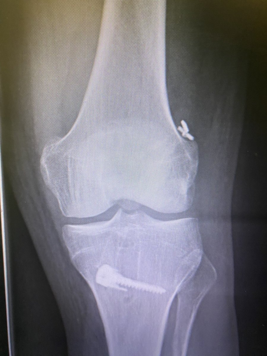 DrNickColyvas's tweet photo. One stage revision (quad autograft).  Managed to avoid having to take out the monster screw and bone graft.  Patient is now 11 months out and ready to ski ! #orthotwitter #revisionacl https://t.co/5baIBlYSNo