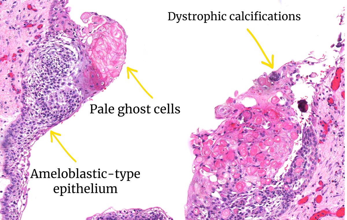 Adult, maxillary cyst. What’s your diagnosis? #oralpath #headandneckpath #ENTpath