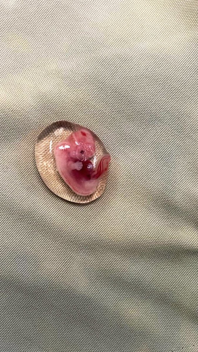 jamesrmendoza's tweet photo. An embryo from our
patient with an ectopic
pregnancy. A little baby at 8 weeks old. Already with a heartbeat. This little person is beautiful in the eyes of God, no more, no less https://t.co/FuVH9mXByt
