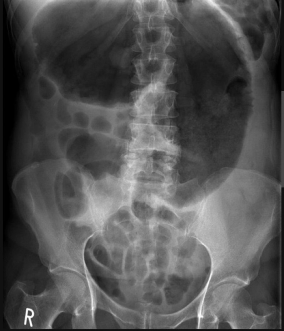 Brown Hospital Medicine on Twitter "A patient presented with abdominal