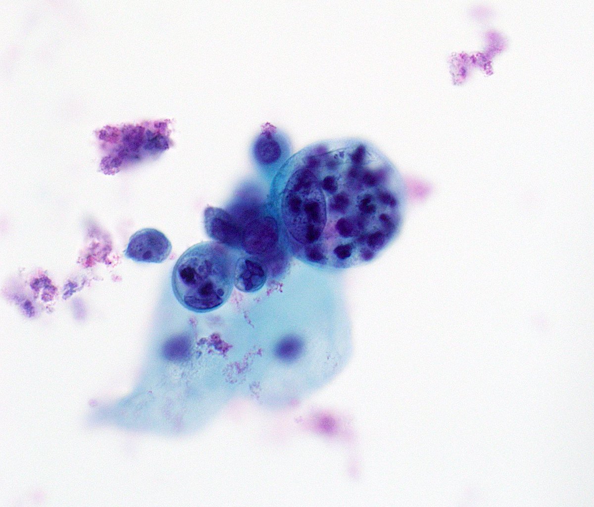 Pap smear- endometrial adenocarcinoma-characteristic intracytoplasmic neutrophils. 
#Pathresidents #cytology #cytopathology #ThinPrep  #gynpath