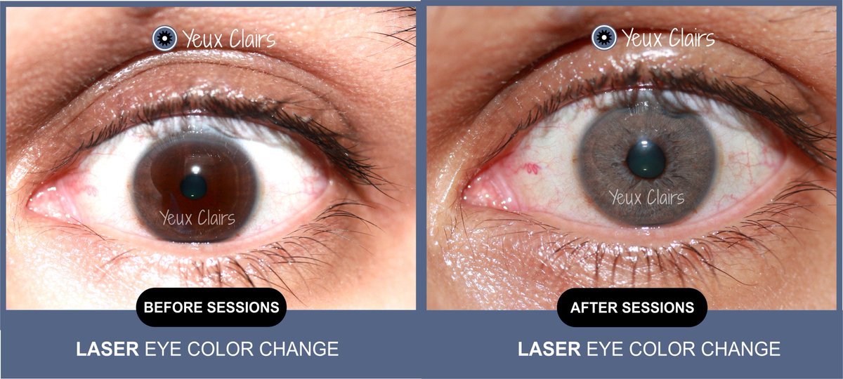 yeuxclairslaser's tweet photo. Before & After. | Laser eye color change.
More info: https://t.co/efSDuD9LYk
#yeuxclairs #eyecolorchange #laser #process #realresult https://t.co/HksZo6fdsl