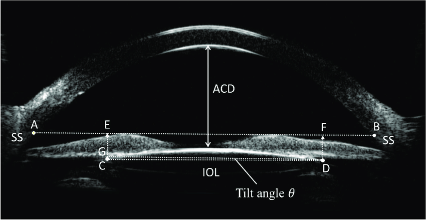 joaquinfdezoft's tweet photo. 1/ ¿En qué medida influye el #Tilt y el #Descentramiento d las #IOLsMultifocales en la #CalidadVisión d los Pacientes y cómo podríamos predecirlo en el preoperatorio? https://t.co/1n2lNQY3Wr