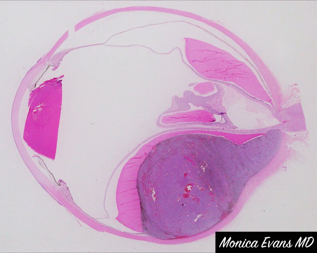 JMGardnerMD's tweet photo. Eye enucleation from an adult. Your diagnosis? Where does it usually metastasize first? Answers: https://t.co/jXolra2tmK. Amazing pics by Dr. Monica Evans. #pathologists #pathology #pathTwitter #grosspath #Ophthotwitter #ophtho #MedStudentTwitter #medtwitter https://t.co/ObB5aA4kqV
