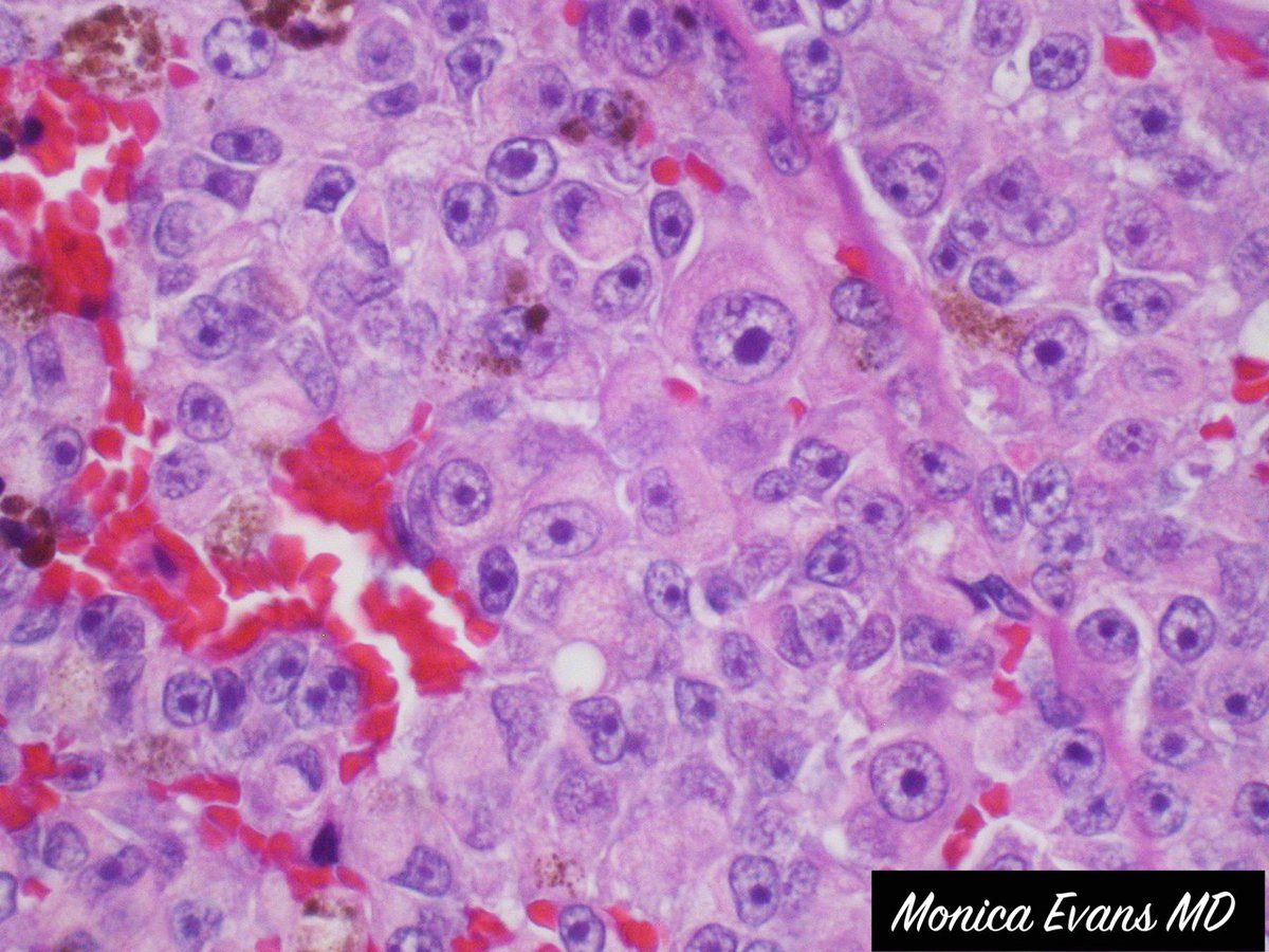 JMGardnerMD's tweet photo. Eye enucleation from an adult. Your diagnosis? Where does it usually metastasize first? Answers: https://t.co/jXolra2tmK. Amazing pics by Dr. Monica Evans. #pathologists #pathology #pathTwitter #grosspath #Ophthotwitter #ophtho #MedStudentTwitter #medtwitter https://t.co/ObB5aA4kqV