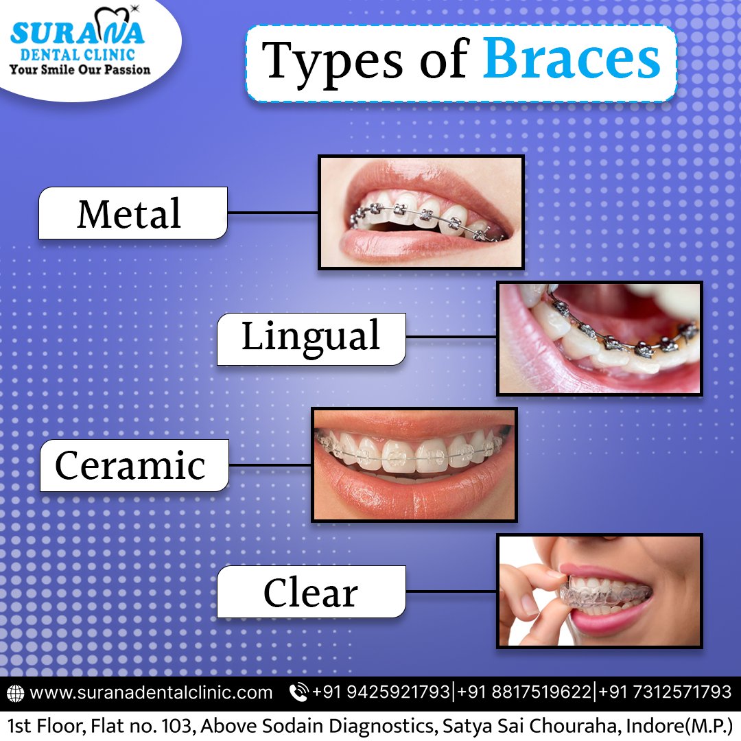 Types of Braces
.
.
#braces #metalbraces #lingualbraces #ceramicbraces #ClearBraces #dentalbraces #teethlife #EmpoweringYouth #SaturdayMotivation #ujjain #indorecity #dentistryworld #tratamentodecanal #dentaltreatment #suranadentalclinic #suranadentalclinicindore