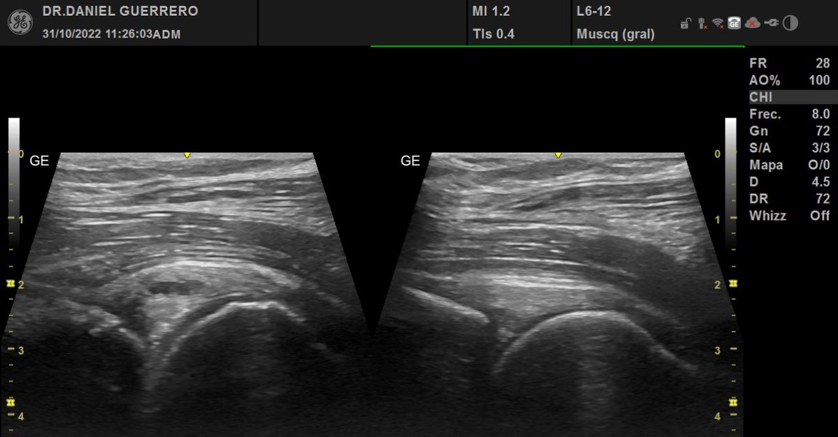 La cadera que no mejora con terapia Coxartrosis , quiste asociado