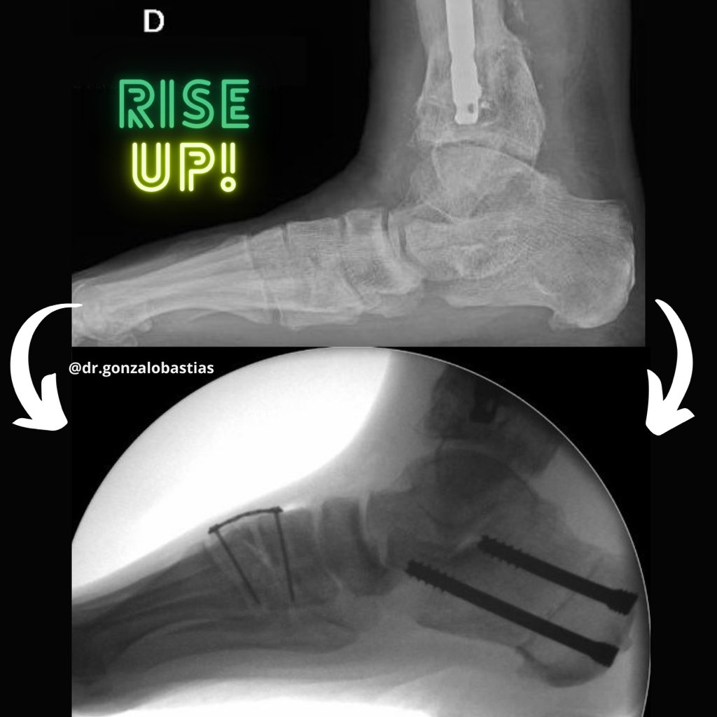 Rising Arch ⬆️⬆️ ⬆️ #flatfeet #flatfoot #pesplanus #osteotomies #orthopedics #pieplano #orthotwitter #ortopedia