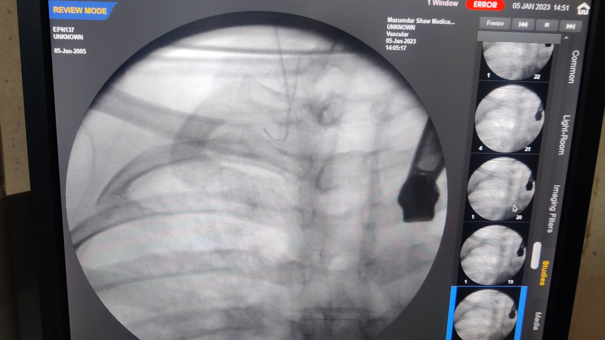 thisis_drgsp's tweet image. #micropuncture kit is such a boon for patients with thrombosed IJV

Pic : 1 not able to pass the guidewire due to thrombus

Pic 2:  guidewire has gone after puncturing the thrombus with micropuncture guidewire 

Pic 3: final outcome

@AVATAROrg @prashantnephro @fearingforties