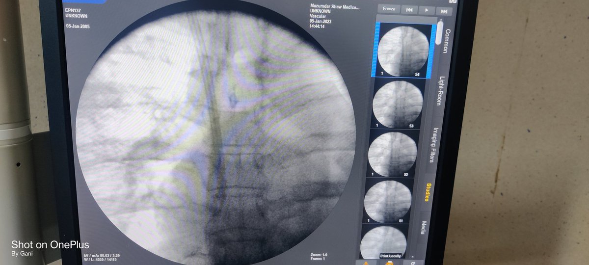 thisis_drgsp's tweet image. #micropuncture kit is such a boon for patients with thrombosed IJV

Pic : 1 not able to pass the guidewire due to thrombus

Pic 2:  guidewire has gone after puncturing the thrombus with micropuncture guidewire 

Pic 3: final outcome

@AVATAROrg @prashantnephro @fearingforties