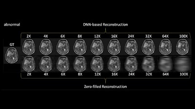 Radiology_AI's tweet photo. Exploring the Acceleration Limits of Deep Learning VarNet-based 2-D Brain MRI https://t.co/suLntUhgZY @NYUImaging @aibe_fau @UniFAU #ImageReconstruction #undersampling #AI https://t.co/bVMvYalLTJ