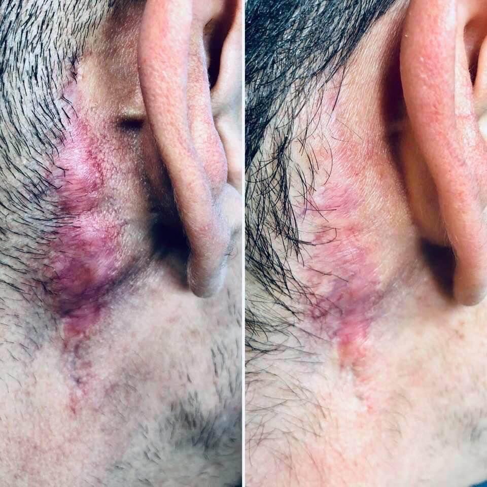 drsinanibis's tweet photo. Ameliyat, yara, yanık izleri ve keloidler NliteV Lazer ile adım adım küçültülüyor #flaviusklinik #drsinanibiş #iztedavisi #keloid #scarreduction #nliteVlazer https://t.co/8dLFoQCpQ5