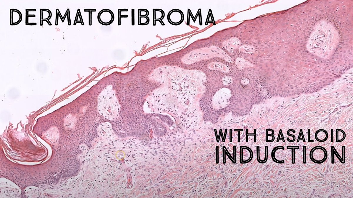 Jerad Gardner, MD on Twitter "Dermatofibroma with basaloid follicular